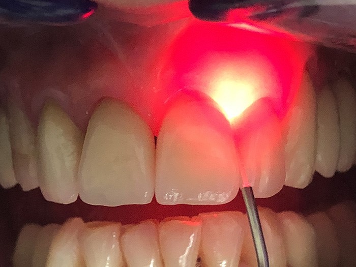 آشنایی با نحوه درمان با لیزر در دندانپزشکی 