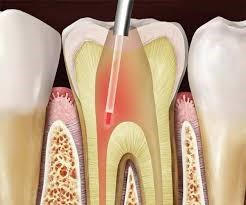 مزایای درمان با لیزر در دندانپزشکی