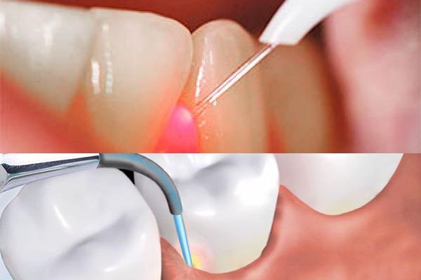 انواع لیزر های مورد استفاده در دندانپزشکی