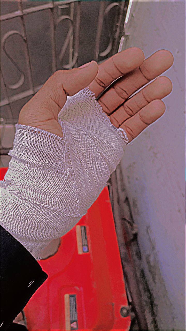 عکس فیک بیمارستان پا شکسته