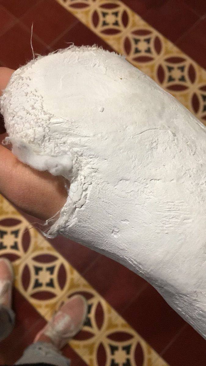 عکس فیک بیمارستان پا شکسته