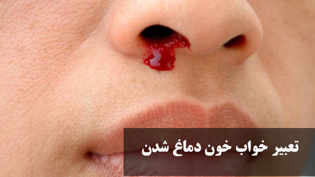 تعبیر خواب خون دماغ شدن مادر