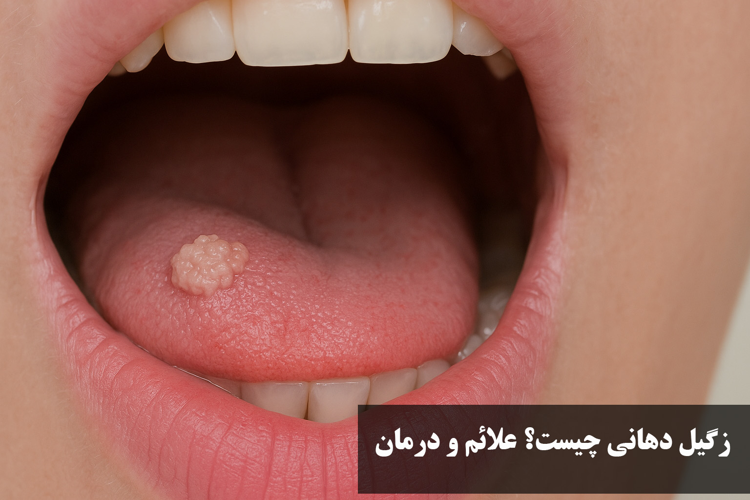 زگیل دهانی چیست؟ علائم، قرص و تفاوت با آفت دهانی + عکس