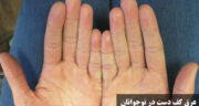 علت عرق کف دست در نوجوانان + درمان‌ های خانگی و دارویی