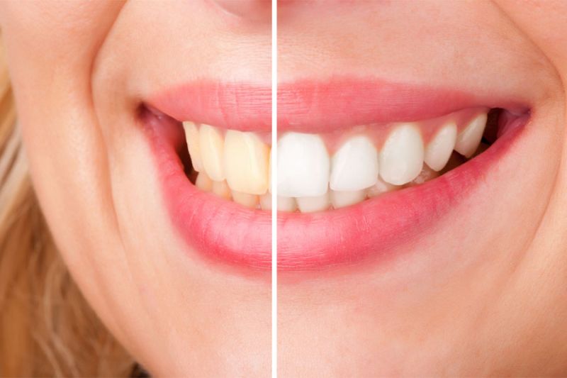 روش های از بین بردن اثرات سیگار از روی دندان
