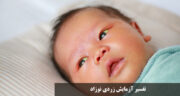 تفسیر آزمایش زردی نوزاد (bilirubin direct) آزمایش زردی نوزاد باید چند باشد + جدول درجه بندی زردی نوزاد