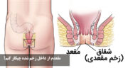 مقعدم از داخل زخم شده چیکار کنم؟ پماد و درمان خانگی زخم معقعد بر اثر رابطه و یبوست