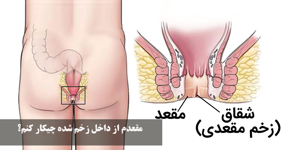 مقعدم از داخل زخم شده چیکار کنم؟