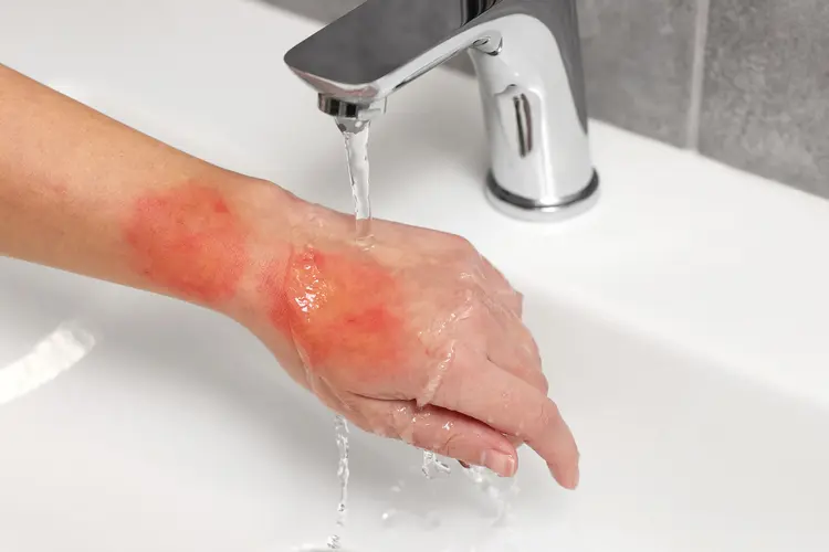 بهترین پماد سوختگی خانگی