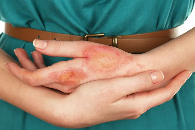 عسل پزشکی: ضدعفونیکننده قدرتمند و خانگی