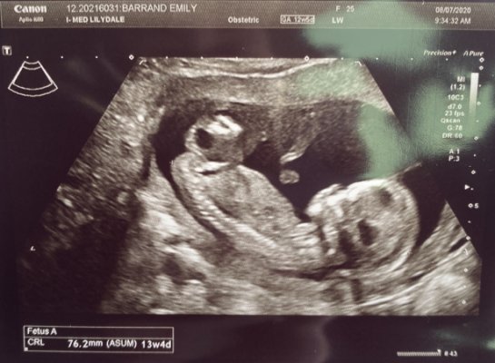 جفت قدامی چیست؟