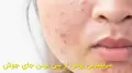 سریعترین روش از بین بردن جای جوش کمترین زمان خانگی (100% تضمینی)